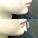 ヒアルロン酸注入（あご） / ボトックス（エラ・小顔） TCB東京中央美容外科 堺院 AFTER サムネイル用