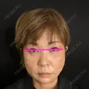 二重埋没 / 糸リフト / クマ治療 / ヒアルロン酸注入（あご） / ボトックス（肩） / ボトックス（眉間） / ボトックス（首） / ヒアルロン酸注入（首） 藤・ナチュレ美容クリニック 銀座院 AFTER サムネイル用