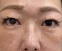 下まぶたたるみ取り / 下まぶたの脂肪取り / 脂肪注入（目の下） 湘南美容クリニック 千葉センシティ院 DAY 8 サムネイル用