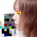 鼻尖形成（切開） / 軟骨移植 / ヒアルロン酸注入（鼻） / ヒアルロン酸注入（あご） ASTRA BEAUTY CLINIC DAY 5 サムネイル用