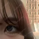 ヒアルロン酸注入（涙袋） ファイヤークリニック 銀座院 DAY 3 サムネイル用