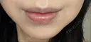 ボトックス（あご） ルラ美容クリニック 名古屋本院 DAY 7 サムネイル用