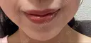 ボトックス（あご） ルラ美容クリニック 名古屋本院 DAY 9 サムネイル用