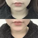 ヒアルロン酸注入（あご） / ボトックス（エラ・小顔） TCB東京中央美容外科 堺院 DAY 0 サムネイル用