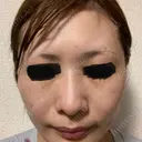美肌レーザー / ピコレーザートーニング（美白・肝斑） CLINIC W AFTER サムネイル用