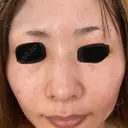 美肌レーザー / ピコレーザートーニング（美白・肝斑） CLINIC W DAY 5 サムネイル用
