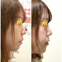 鼻尖形成（切開） / 軟骨移植 / ヒアルロン酸注入（鼻） / ヒアルロン酸注入（あご） ASTRA BEAUTY CLINIC DAY 6 サムネイル用