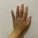 脂肪吸引（二の腕） / 脂肪吸引（肩） ルーチェクリニック 銀座院 DAY 8 サムネイル用