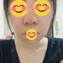 鼻尖形成（切開） / 鼻中隔延長（切開） / 小鼻縮小（切開） / バッカルファット除去 / 脂肪吸引（顔） / 軟骨移植 / 眉間プロテーゼ / 鼻尖縮小 ジョウクリニック 大阪院 DAY 13 サムネイル用