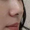 小鼻縮小（切開） 山本クリニック DAY 42 サムネイル用