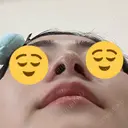 小鼻縮小（切開） 山本クリニック DAY 42 サムネイル用