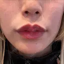 ボトックス（あご） / ヒアルロン酸注入（あご） / ヒアルロン酸注入（唇） 銀座みゆき通り美容外科 大阪梅田院 DAY 7 サムネイル用