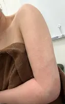 脂肪吸引（二の腕） / 脂肪吸引（肩） 湘南美容クリニック 長野院 DAY 1 サムネイル用