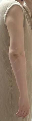 脂肪吸引（二の腕） / 脂肪吸引（脚） / ボトックス（ふくらはぎ） / ボトックス（二の腕） Mods Clinic（モッズクリニック） 福岡院 DAY 197 サムネイル用