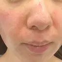 ヴェルヴェットスキン 東京シンデレラ美容外科 大宮院 AFTER サムネイル用