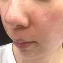 ヴェルヴェットスキン 東京シンデレラ美容外科 大宮院 DAY 0 サムネイル用