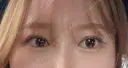 二重切開 Olino美容外科・美容皮膚科 DAY 48 サムネイル用