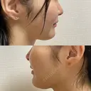 ピコスポット L‘amour clinic Tokyo【ラムールクリニック東京】 DAY 1 サムネイル用