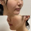 ピコスポット L‘amour clinic Tokyo【ラムールクリニック東京】 DAY 1 サムネイル用