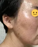 シミ取りレーザー / ピコスポット Olino美容外科・美容皮膚科 DAY 10 サムネイル用