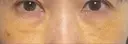 下まぶたの脂肪取り / 脂肪注入（肌） / 脂肪注入（目の下） X CLINIC 大阪院 DAY 7 サムネイル用