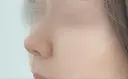 軟骨移植 ソウルクイーン整形外科（旧コエンミ整形外科） DAY 447 サムネイル用