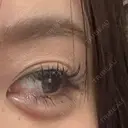 ヒアルロン酸注入（涙袋） ファイヤークリニック 銀座院 DAY 6 サムネイル用