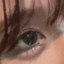 ヒアルロン酸注入（涙袋） ファイヤークリニック 銀座院 DAY 7 サムネイル用