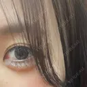 ヒアルロン酸注入（涙袋） ファイヤークリニック 銀座院 DAY 8 サムネイル用