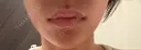 ヒアルロン酸注入（あご） お肌のクリニック　高田馬場 AFTER サムネイル用