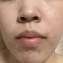 ポテンツァ 渋谷美容外科クリニック 横浜院 DAY 1 サムネイル用