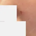 ほくろ・いぼ除去レーザー（肌） フェアクリニック川口 DAY 4 サムネイル用