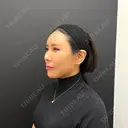 ヒアルロン酸注入（唇） シェリークリニック 新宿本院 DAY 0 サムネイル用