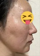 シミ取りレーザー / ピコスポット Olino美容外科・美容皮膚科 DAY 13 サムネイル用