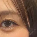 ヒアルロン酸注入（涙袋） ファイヤークリニック 銀座院 AFTER サムネイル用