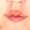 ヒアルロン酸注入（唇） / ボトックス（口角） ルラ美容クリニック 札幌本院 DAY 0 サムネイル用