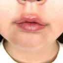 ヒアルロン酸注入（唇） / ボトックス（口角） ルラ美容クリニック 札幌本院 DAY 0 サムネイル用