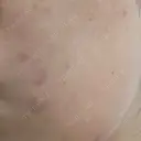 ポテンツァ 渋谷美容外科クリニック 横浜院 DAY 2 サムネイル用