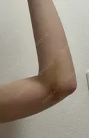 脂肪吸引（二の腕） イテウォンビューティークリニック 名古屋栄院 DAY 17 サムネイル用