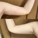 脂肪吸引（二の腕） / 脂肪吸引（肩） 湘南美容クリニック 長野院 DAY 7 サムネイル用