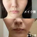 ピコスポット L‘amour clinic Tokyo【ラムールクリニック東京】 DAY 3 サムネイル用