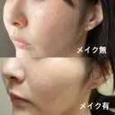 ピコスポット L‘amour clinic Tokyo【ラムールクリニック東京】 DAY 3 サムネイル用