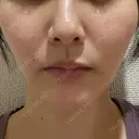 ピコスポット L‘amour clinic Tokyo【ラムールクリニック東京】 AFTER サムネイル用