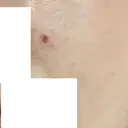 ほくろ・いぼ除去レーザー（肌） フェアクリニック川口 DAY 6 サムネイル用