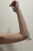 脂肪吸引（二の腕） イテウォンビューティークリニック 名古屋栄院 DAY 18 サムネイル用