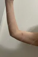 脂肪吸引（二の腕） イテウォンビューティークリニック 名古屋栄院 DAY 18 サムネイル用