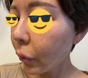 ヒアルロン酸注入（鼻） プリモ麻布十番クリニック DAY 2 サムネイル用
