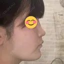 隆鼻術 / 鼻尖形成（切開） / 鼻中隔延長（切開） / 軟骨移植 R Beauty CLINIC 銀座院 AFTER サムネイル用