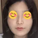 隆鼻術 / 鼻尖形成（切開） / 鼻中隔延長（切開） / 軟骨移植 R Beauty CLINIC 銀座院 DAY 42 サムネイル用