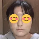 隆鼻術 / 鼻尖形成（切開） / 鼻中隔延長（切開） / 軟骨移植 R Beauty CLINIC 銀座院 DAY 14 サムネイル用